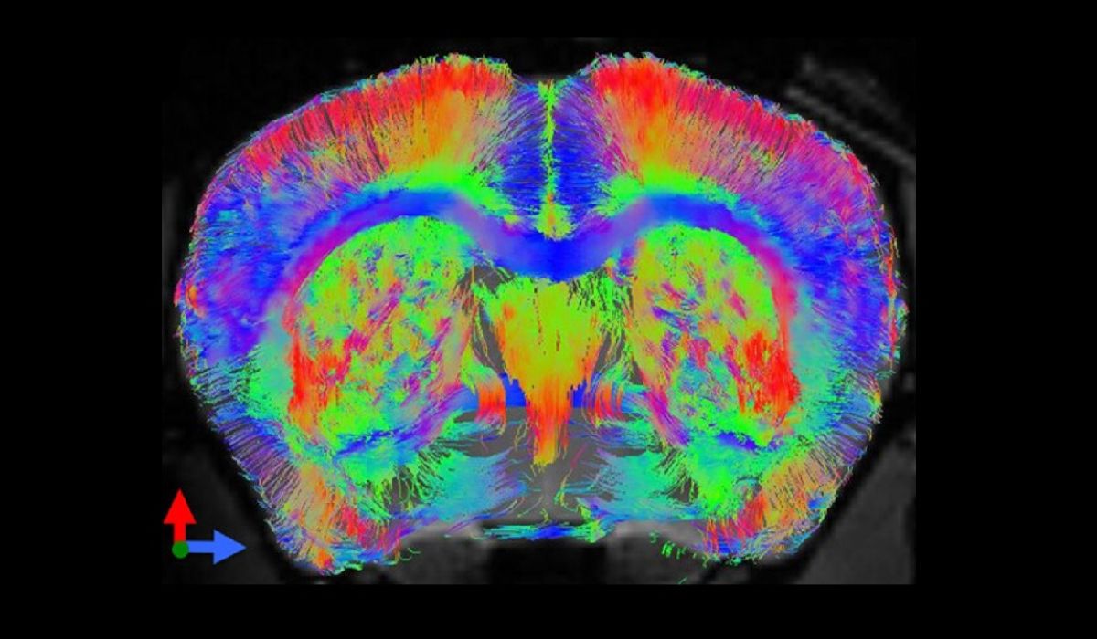 Huntington’s disease neurodegeneration brain scan