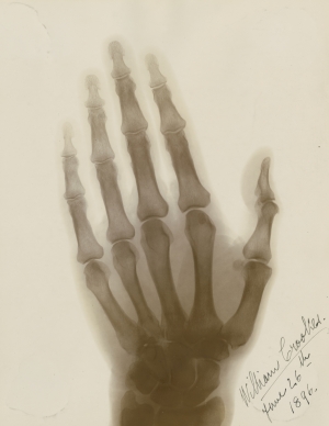 An early x-ray photograph of Sir William Crookes’s hand