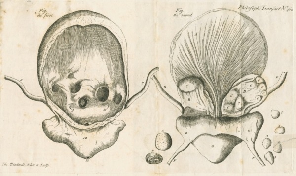 Two illustrations by Elizabeth Blackwell showing front and back views of the bladder of the late Mr Gardiner.