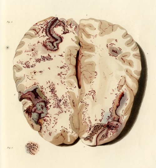 Plate 6 from 'Bright's Medical Reports: Diseases of the brain and Nervous System part 1' by Richard Bright (c) The Royal Society
