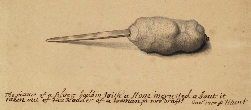 Henry Hunt’s sketch of a silver bodkin encrusted in a bladder stone