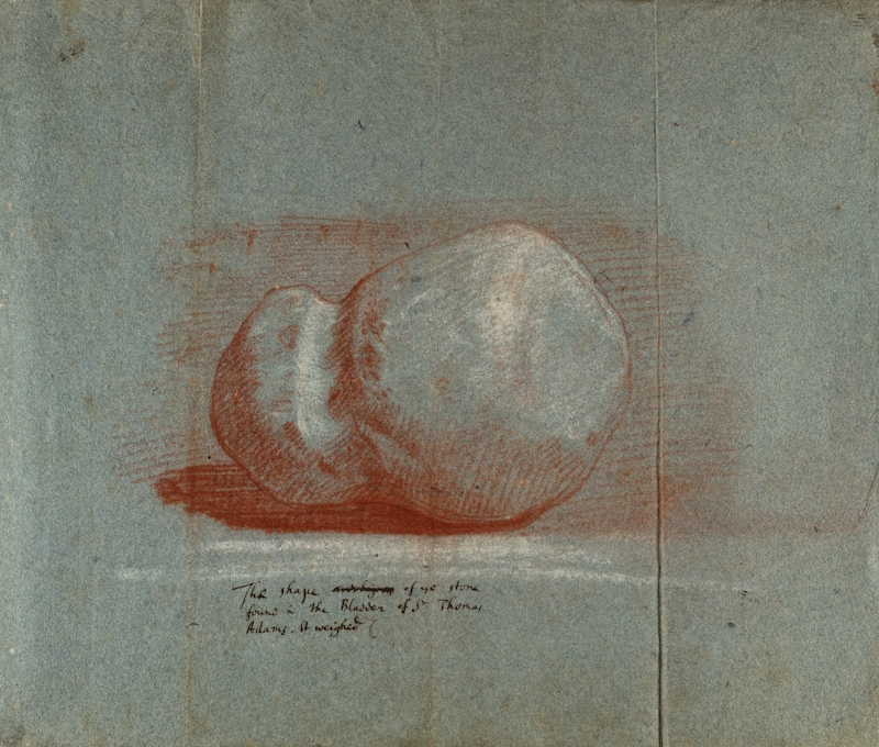 Drawing of a bladder stone by Robert Hooke, 1668