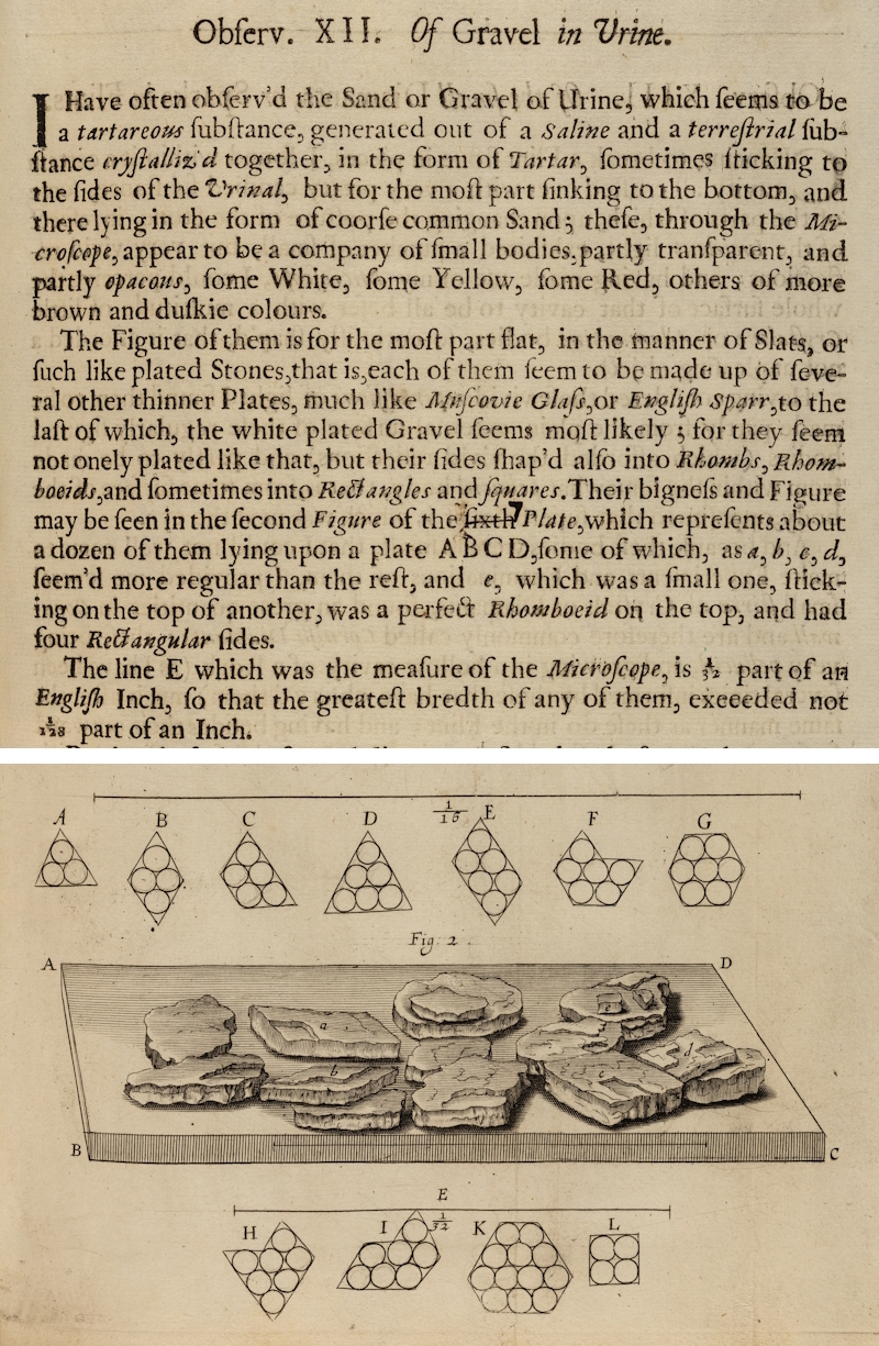 Robert Hooke’s observation of ‘Gravel in Urine’, 1665