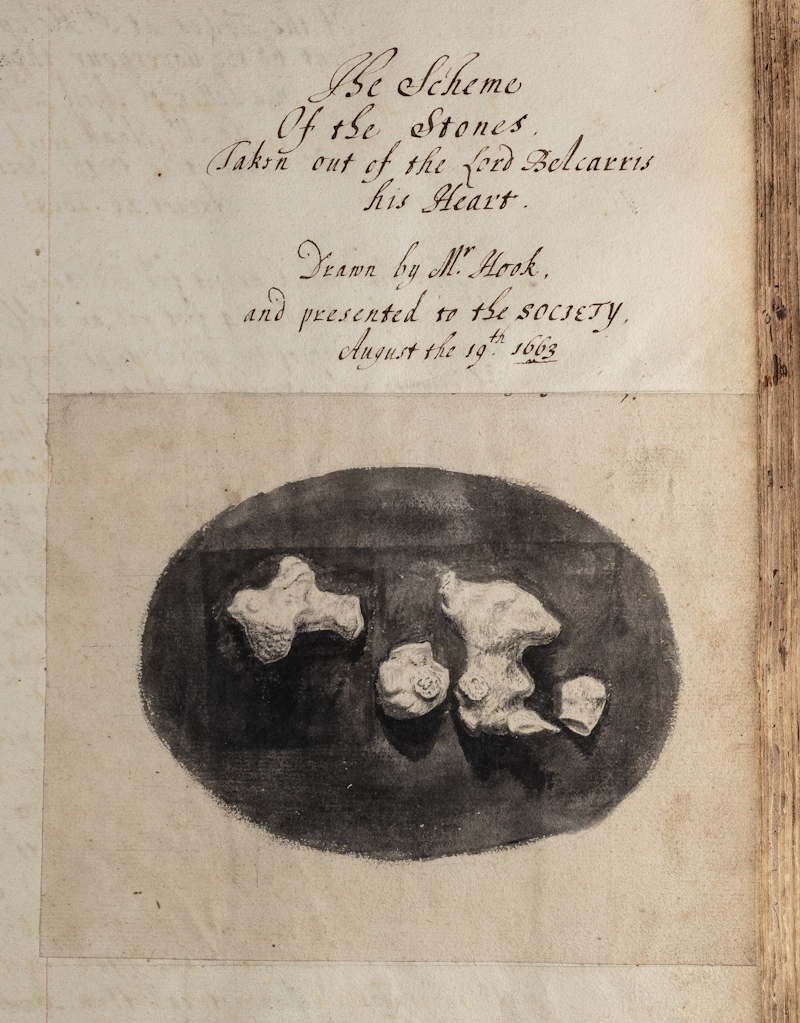 Stones from the heart of the Earl of Balcarres, 1663