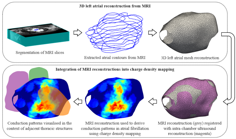 Graphical abstract showing 3D left atrial reconstruction from MRI.