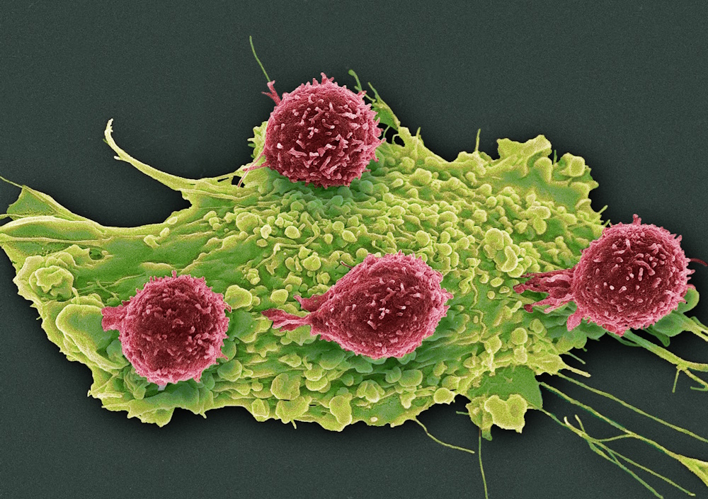 Lymphocytes attached to a cancer cell.