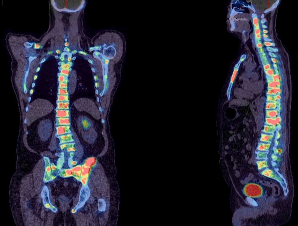 Whole body fused PET and CT image of a patient with prostate cancer. This image shows multiple areas of abnormal 18F-fluoride uptake throughout the skeleton (red and yellow spots) indicating spread of cancer to these sites. Whilst the extent of spread of cancer is large, the uptake would predict that this patient should respond well to a targeted radionuclide treatment such as 223-Radium Chloride.