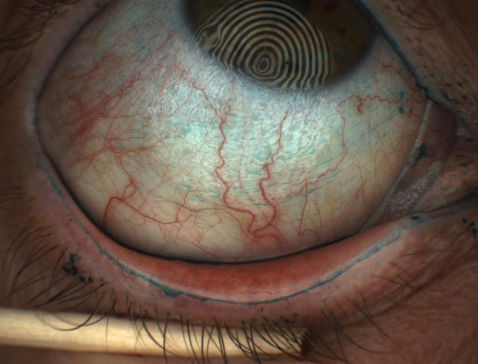 Imaging of tear film instability and resulting damage to the ocular and eyelid tissue (highlighted by the green dye). Credit: Aston University